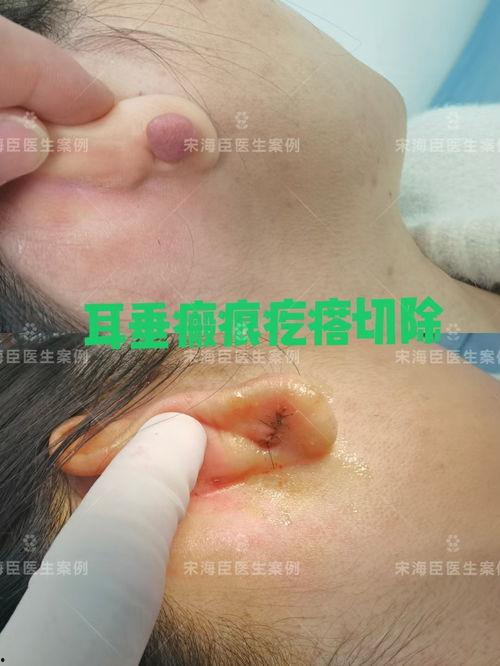 伤疤在线观看,揭开心灵创伤的治愈之旅 第3张 伤疤在线观看,揭开心灵创伤的治愈之旅 第3张